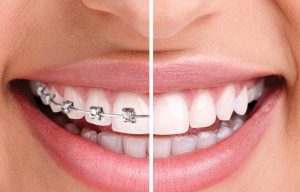 Ortodontik Meselelerin Sebepleri