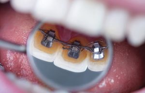 ortodontik tedavi esnasinda disler nasil hareket eder