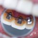 ortodontik tedavi esnasinda disler nasil hareket eder